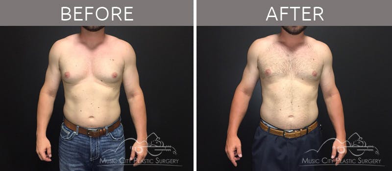 Gynecomastia Before & After Gallery - Patient 90709249 - Image 2