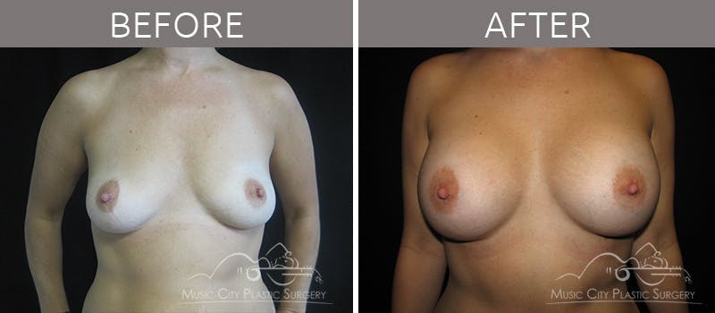 Breast Augmentation Before & After Gallery - Patient 90709250 - Image 2