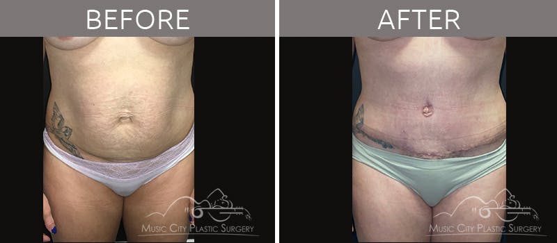 Mommy Makeover Before & After Gallery - Patient 90709253 - Image 4