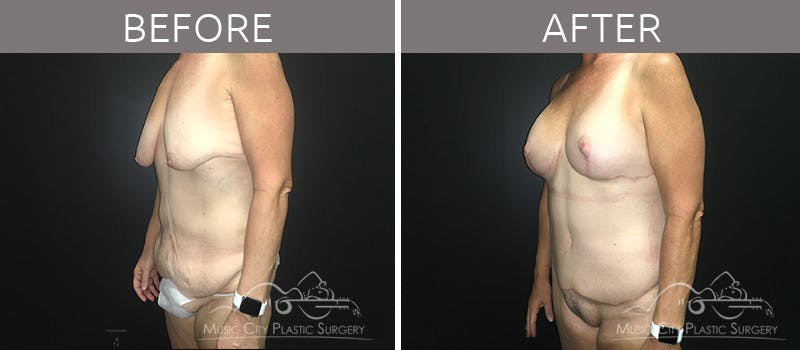 Breast Lift with Augmentation Before & After Gallery - Patient 132099617 - Image 2