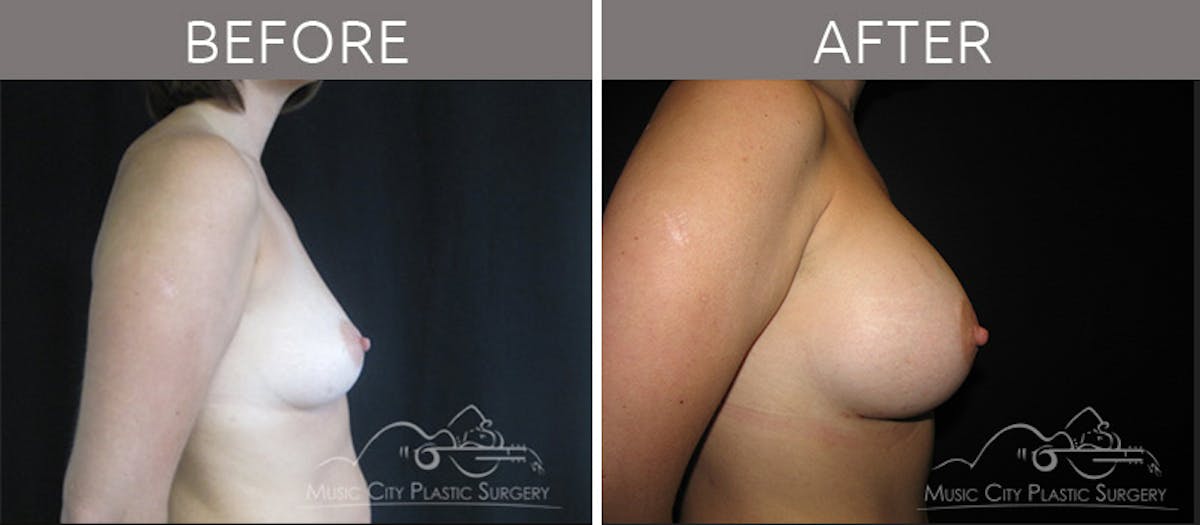 Breast Augmentation Before & After Gallery - Patient 90709250 - Image 3