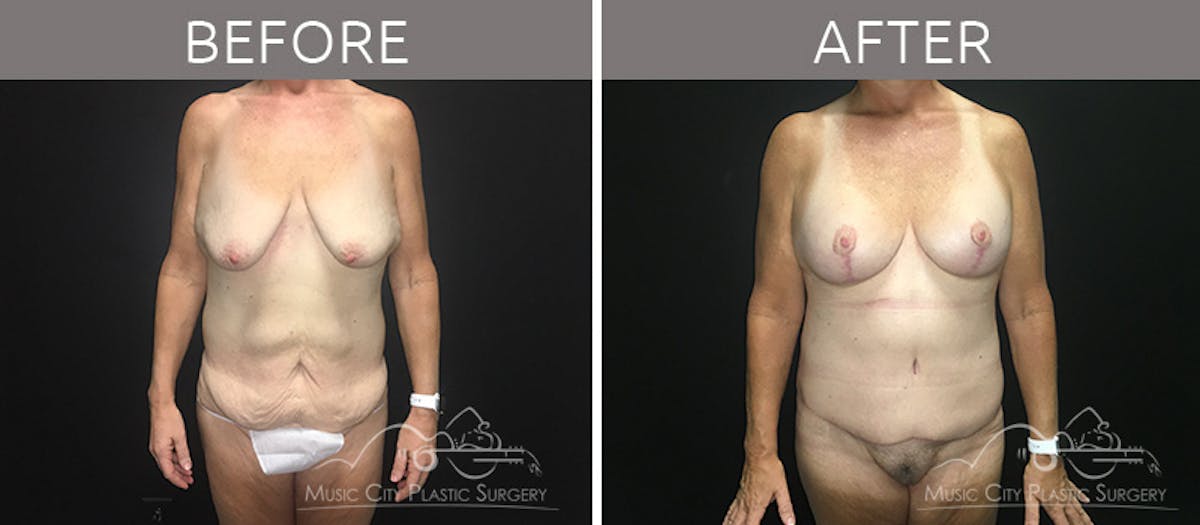 Breast Lift with Augmentation Before & After Gallery - Patient 132099617 - Image 1