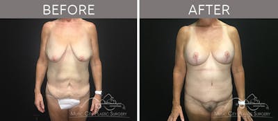 Breast Lift with Augmentation Before & After Gallery - Patient 132099617 - Image 1