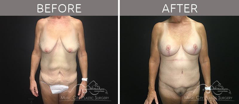 Breast Lift with Augmentation Before & After Gallery - Patient 132099617 - Image 1