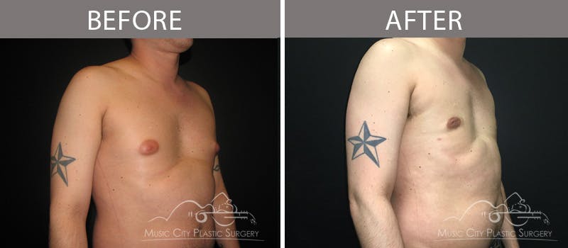 Gynecomastia Before & After Gallery - Patient 90709251 - Image 1