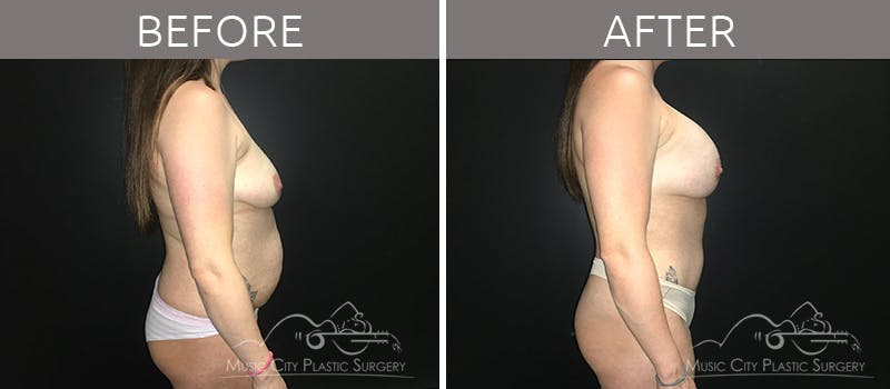 Mommy Makeover Before & After Gallery - Patient 90709253 - Image 6