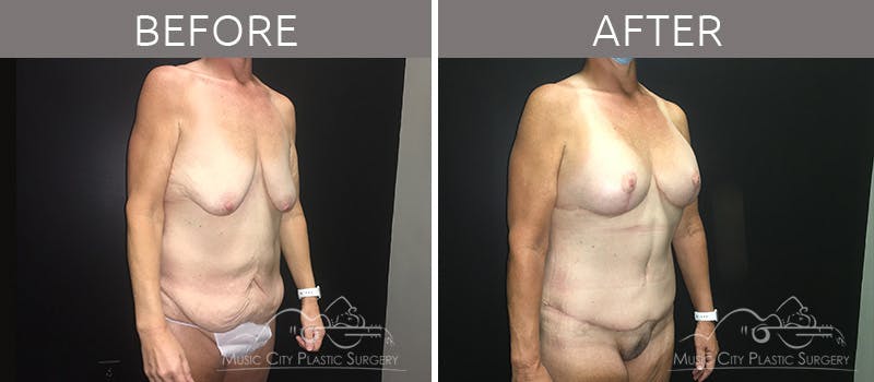Breast Lift with Augmentation Before & After Gallery - Patient 132099617 - Image 4