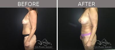 Breast Augmentation Before & After Gallery - Patient 90709261 - Image 3