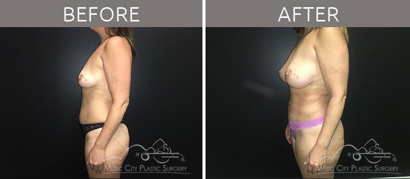 Breast Augmentation Before & After Gallery - Patient 90709261 - Image 1