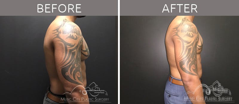 Gynecomastia Before & After Gallery - Patient 90709262 - Image 1