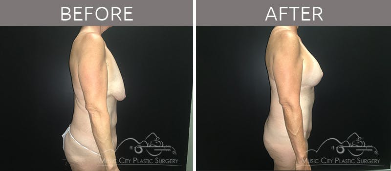 Breast Lift with Augmentation Before & After Gallery - Patient 132099617 - Image 5