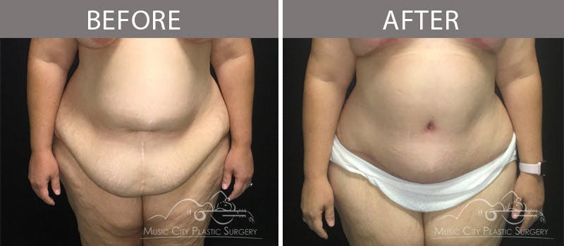 Mommy Makeover Before & After Gallery - Patient 90709266 - Image 1