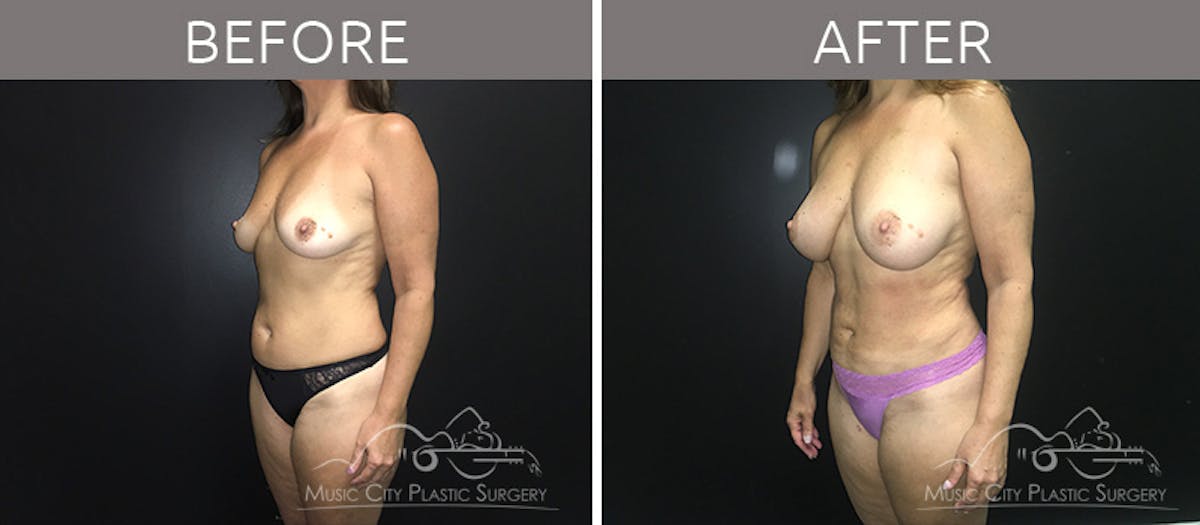 Breast Augmentation Before & After Gallery - Patient 90709261 - Image 2