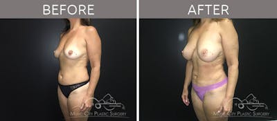 Breast Augmentation Before & After Gallery - Patient 90709261 - Image 2