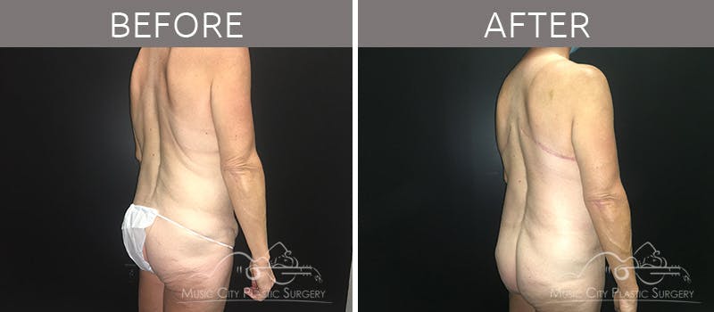 Breast Lift with Augmentation Before & After Gallery - Patient 132099617 - Image 8