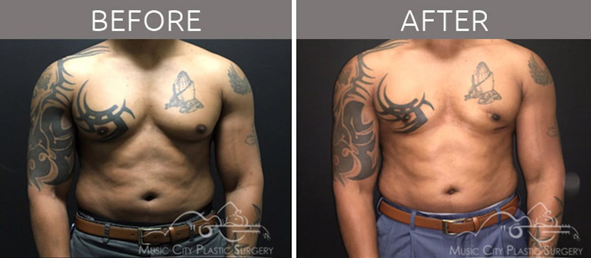 Gynecomastia Before & After Gallery - Patient 90709262 - Image 2