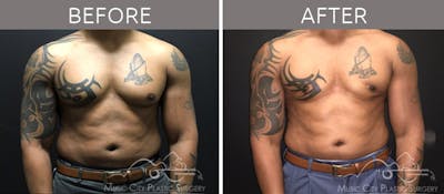 Gynecomastia Before & After Gallery - Patient 90709262 - Image 2