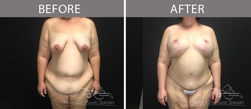 Mommy Makeover Before & After Gallery - Patient 90709266 - Image 2