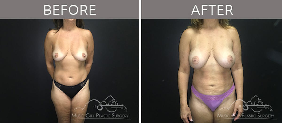 Breast Augmentation Before & After Gallery - Patient 90709261 - Image 1