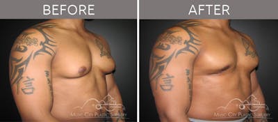 Gynecomastia Before & After Gallery - Patient 90709262 - Image 3