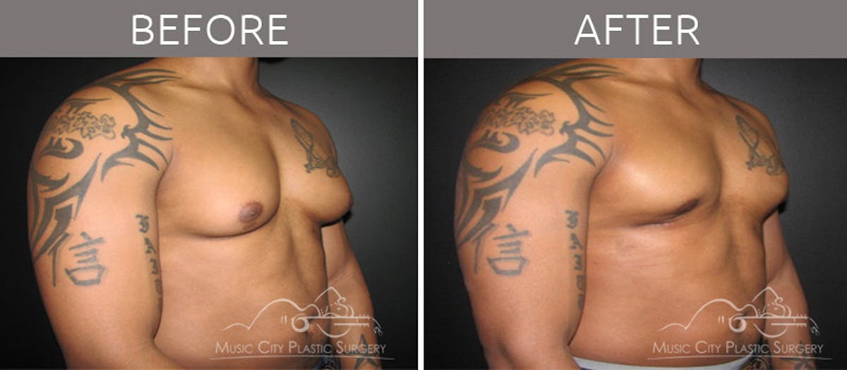 Gynecomastia Before & After Gallery - Patient 90709262 - Image 3