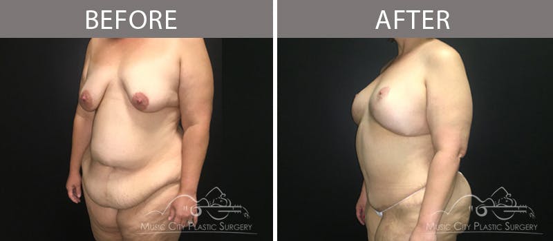 Mommy Makeover Before & After Gallery - Patient 90709266 - Image 3