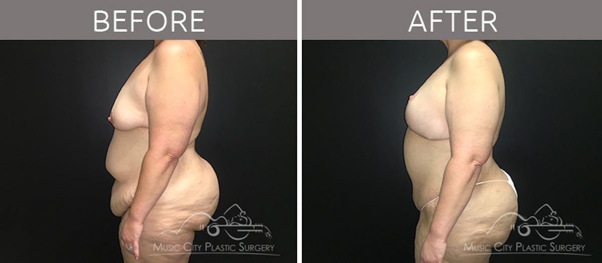 Breast Lift Before & After Gallery - Patient 90709268 - Image 3