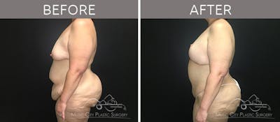 Breast Lift Before & After Gallery - Patient 90709268 - Image 3