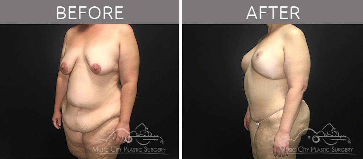 Breast Lift Before & After Gallery - Patient 90709268 - Image 2