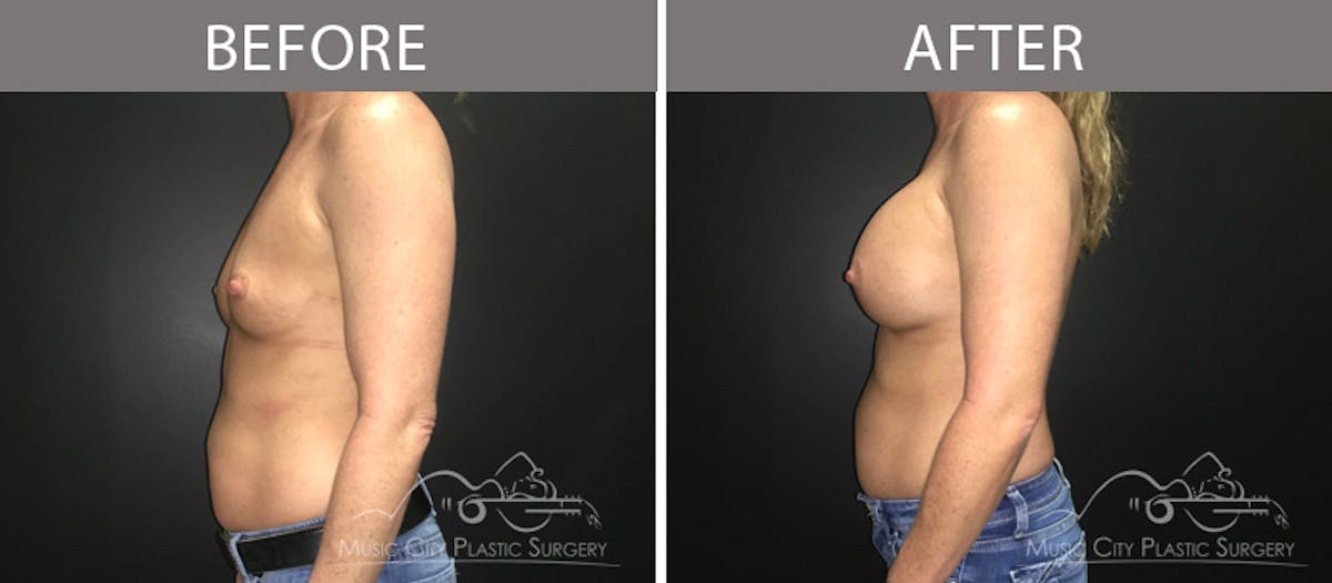 Breast Augmentation Before & After Gallery - Patient 90709267 - Image 3