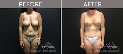 Mommy Makeover Before & After Gallery - Patient 90709270 - Image 1