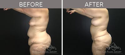 Breast Lift Before & After Gallery - Patient 90709268 - Image 3