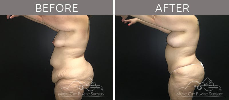 Breast Lift Before & After Gallery - Patient 90709268 - Image 3