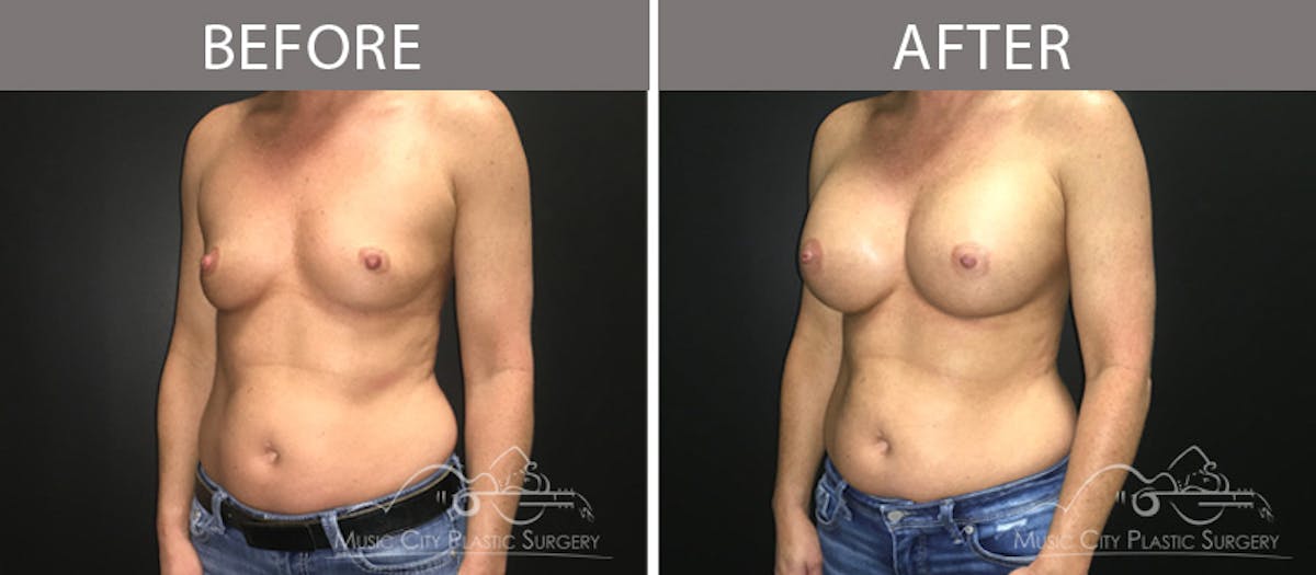 Breast Augmentation Before & After Gallery - Patient 90709267 - Image 2
