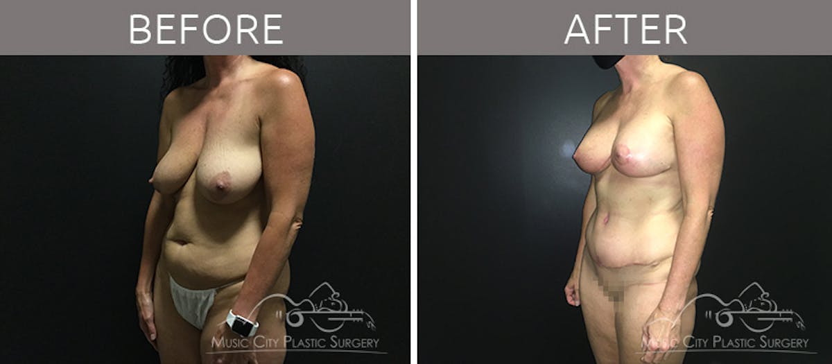 Mommy Makeover Before & After Gallery - Patient 90709270 - Image 2