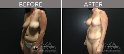 Mommy Makeover Before & After Gallery - Patient 90709270 - Image 2