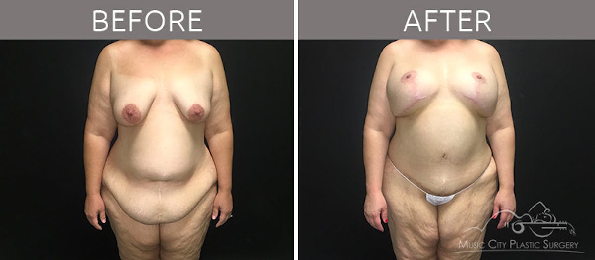 Breast Lift Before & After Gallery - Patient 90709268 - Image 1