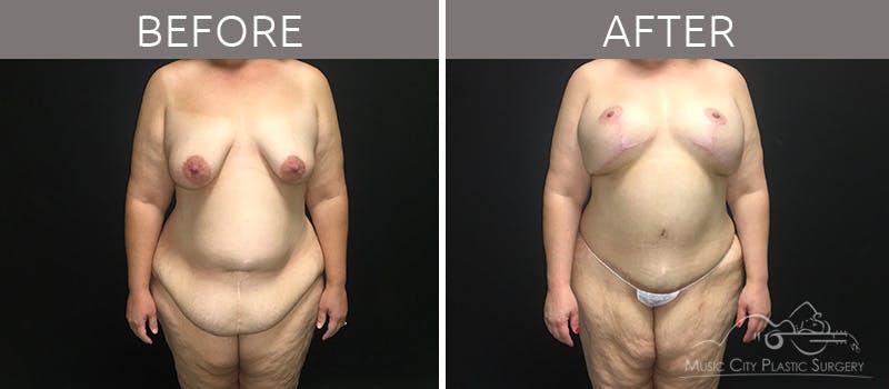 Breast Lift Before & After Gallery - Patient 90709268 - Image 4