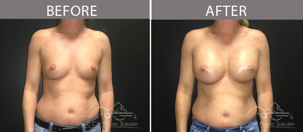 Breast Augmentation Before & After Gallery - Patient 90709267 - Image 1