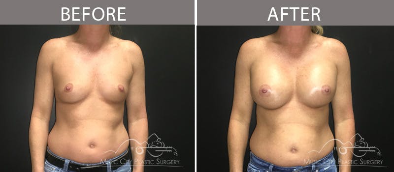 Breast Augmentation Before & After Gallery - Patient 90709267 - Image 3
