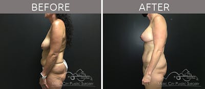 Mommy Makeover Before & After Gallery - Patient 90709270 - Image 3