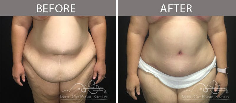 Breast Lift Before & After Gallery - Patient 90709268 - Image 5