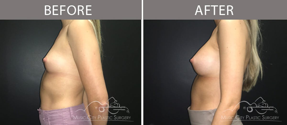 Breast Augmentation Before & After Gallery - Patient 90709269 - Image 3