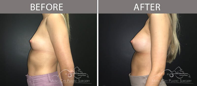 Breast Augmentation Before & After Gallery - Patient 90709269 - Image 1