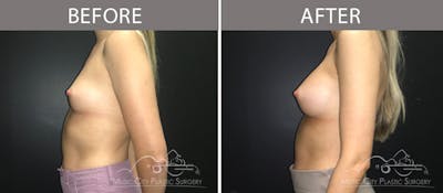 Breast Augmentation Before & After Gallery - Patient 90709269 - Image 3