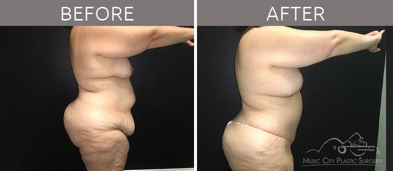 Breast Lift Before & After Gallery - Patient 90709268 - Image 6