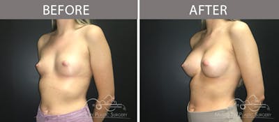 Breast Augmentation Before & After Gallery - Patient 90709269 - Image 2
