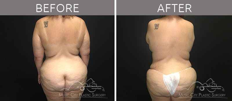 Breast Lift Before & After Gallery - Patient 90709268 - Image 7