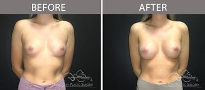 Breast Augmentation Before & After Gallery - Patient 90709269 - Image 1