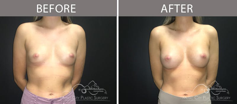 Breast Augmentation Before & After Gallery - Patient 90709269 - Image 3